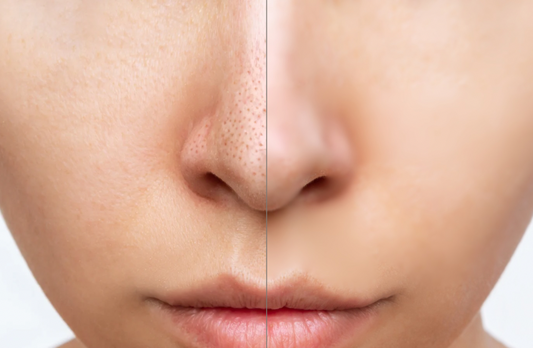 Pore Talk: The Truth About Shrinking Pores and What Actually Works